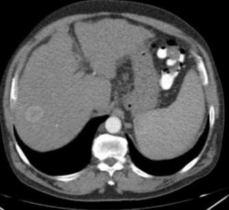 Carcinoma Hepatocelular TC Hipodenso antes de contraste ev