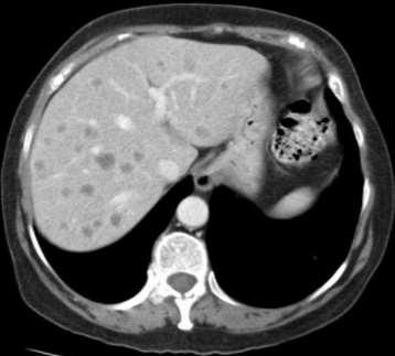 Metástases hepáticas Múltiplos nódulos