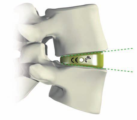 Observação: A escolha do tamanho adequado do Implante de Prova é fundamental.