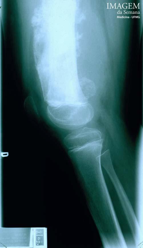 Legenda Imagem 1: Radiografia em perfil de terço distal de fêmur.