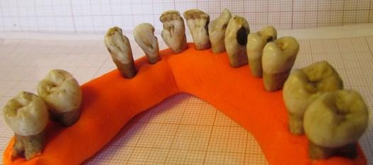 6.5.6.6. Casos particulares Seguem-se figuras ilustrativas de algumas das patologias observadas na amostra dentária.