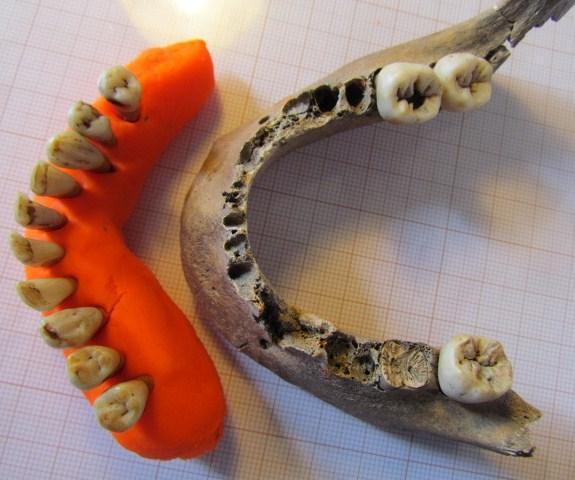 Salientam-se as hipoplasias dos incisivos centrais e caninos e as cavidades cariogénicas. Figura 31- Dentição superior, em norma bucal.