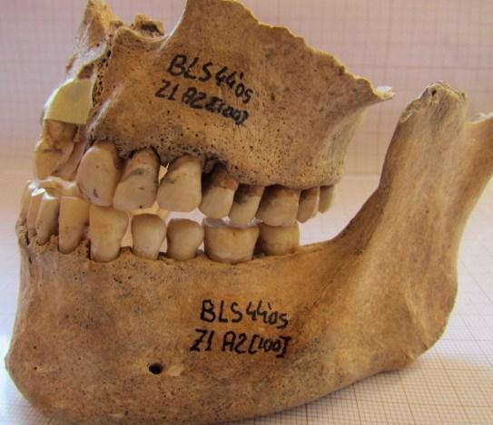 Figura 37- Dentição superior e inferior, em norma bucal e lateral esquerda, apresentando sinais de periodontite [100].