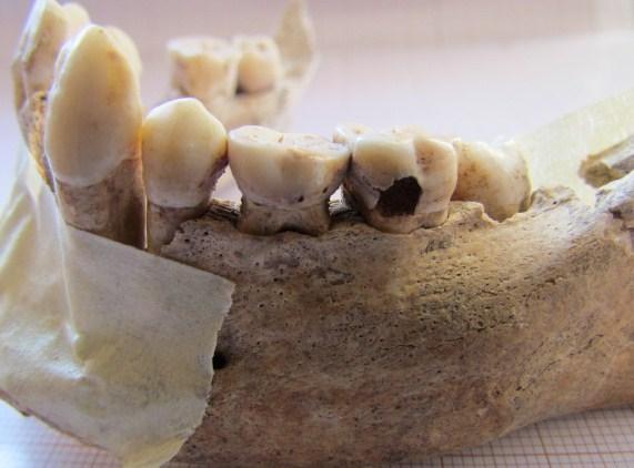 Na figura 39 encontra-se a dentição inferior da criança, em norma bucal e lateral esquerda, assinalando-se o segundo molar
