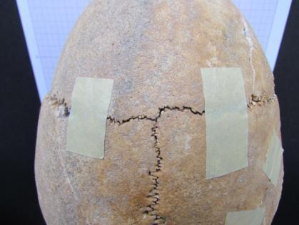 7. Possível caso de modificação craniana post mortem Indivíduo em análise: Identificação: BLA44`05Z1A2 [112] ind.1; Paleobiologia: adulto de meia-idade masculino (Ferembach et al.