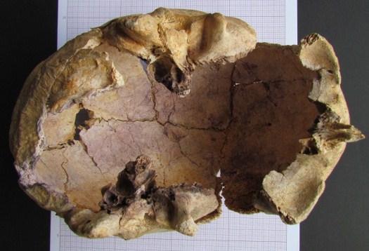 Braço direito por baixo do tronco e o esquerdo em decúbito ventral. Estado de preservação: fraca (figura 91).