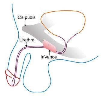 De facto, quando confrontados com a hipótese de lhes ser implantado um esfíncter artificial ou um sling grande parte dos doentes opta por evitar dispositivos mecânicos e escolhe a implantação de um