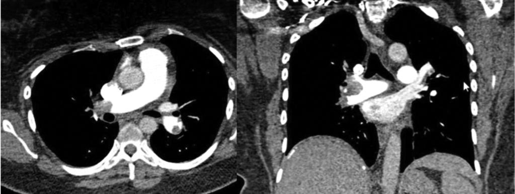 Int J Cardiovasc Sci. 07;30(5):45-458 455 Devido à suspeita clínica, foram solicitados ECOTT, doppler venoso de membros inferiores (MMIIs) e angiotomografia de tórax.