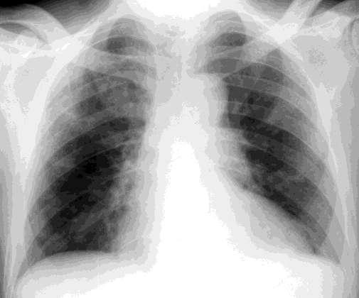 cardiogênico unilateral