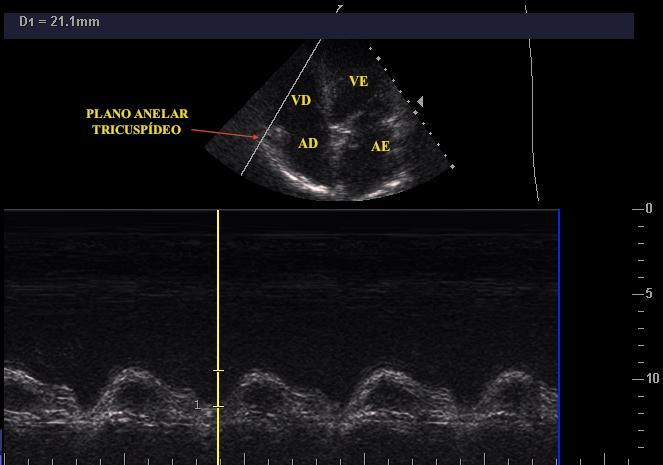 A função ventricular direita pode ser avaliada inicialmente pelo modo subjetivo e apenas a documentação de uma disfunção grave do VD já determina um risco 1,29 vezes maior de óbito (IC 95%: