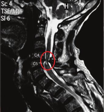 com/blog/how-cervical-stenosis-myelopathy-affects-your-body e de http://clinicbrain.