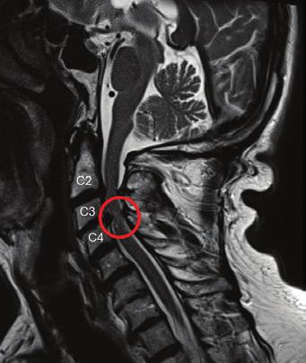 compressão medular e sua localização e a presença de lesões medulares, que poderão ser edematosas (mieloedema) ou atróficas (mielomalácea).