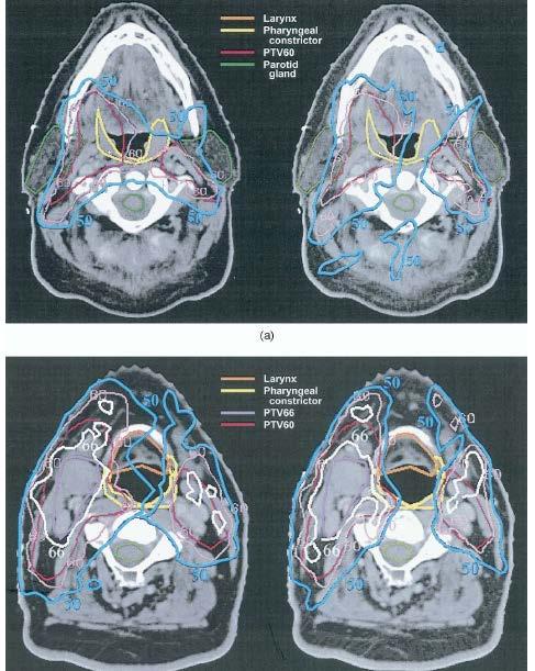 Eisbruch et al.