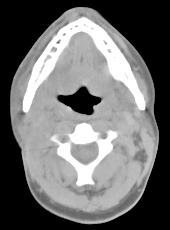 PET-CT