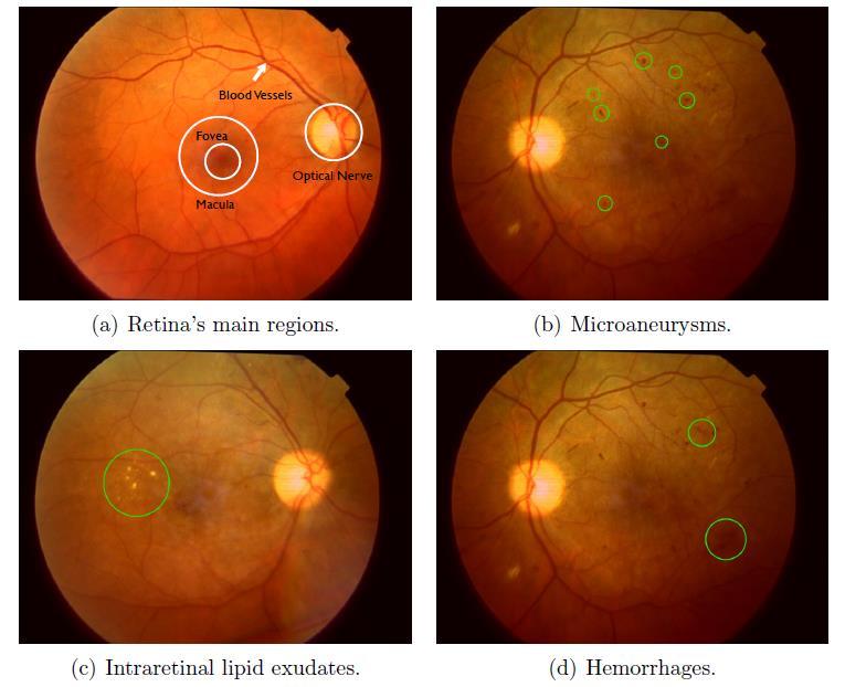 FAPESP-Microsoft Virtual Research Institute Identification of Retinal Pathology (Jacques Wainer, Unicamp) Diabetic retinopathy (DR) Micro vascular retinal changes