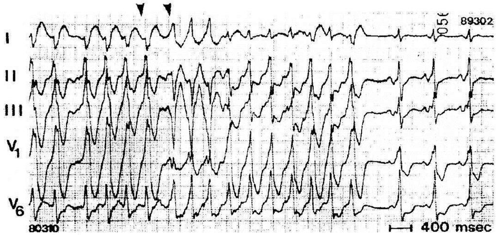 19 Figura 7 Fibrilação atrial em paciente com múltiplas vias anômalas Cinco derivações eletrocardiográficas simultâneas mostrando dois padrões distintos de pré-excitação ventricular durante