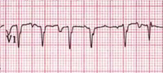 4 7 complexos QRS Frequência cardíaca? Existem ondas p? QRS estreitos ou alargados? Regular ou irregular?