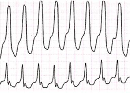 TAQUIARRITMIAS Principais tipos de disritmias Taquicardia ventricular Mecanismo: circuito de reentrada a nível ventricular a