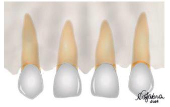 As fibras colágenas de alguns tipos de freio labial podem romper as fibras transeptais, levando ao aparecimento de um diastema mediano (DELLI et al., 2013).