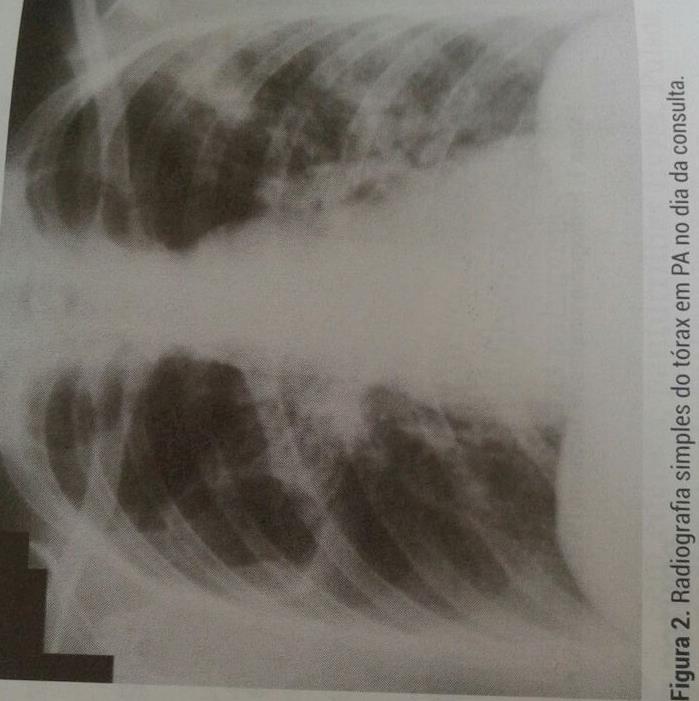 4 esquerdo, possivelmente correspondendo à disseminação brônquica contralateral; BAAR de +++ em duas amostras e cultura para BK positiva, confirmando a hipótese diagnóstica de tuberculose pulmonar.