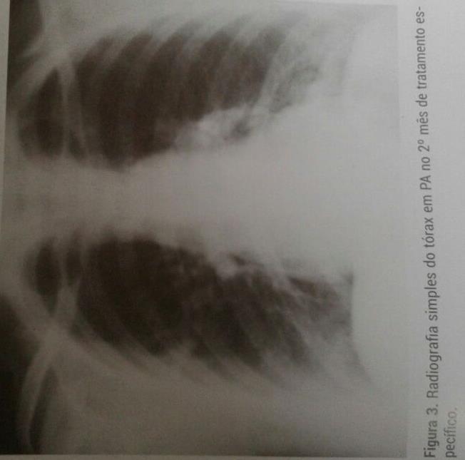 5 (especialmente na primeira fase), acompanhamento por BAAR mensalmente e a realização de raio-x simples de tórax no momento inicial, dois meses após o início do tratamento (se possível) e ao final