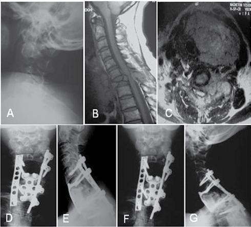 Radiografias pós-operatórias imediatas (B e C) e com um ano de seguimento (E e F) Figura 2 Radiografias (A e B), tomografia computadorizada (C) e ressonância magnética (D) de
