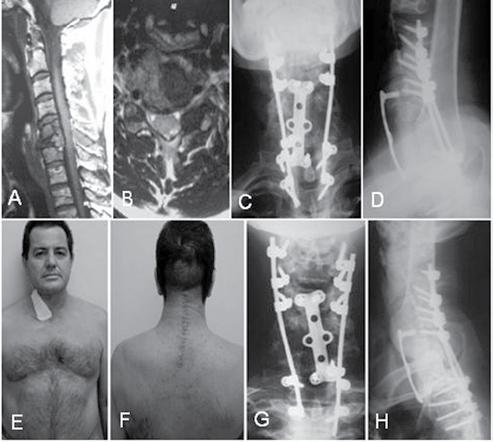 Radiografias pós-operatórias iniciais (E e F) e com um ano de seguimento (G e H) Figura 3 Paciente do sexo feminino com 52 anos e diagnóstico de metástase de tireóide.