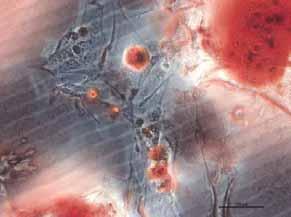 Células cultivadas em meio indutor osteogênico e corado com Vermelho de alizarina evidenciando as mineralizações de cálcio no meio