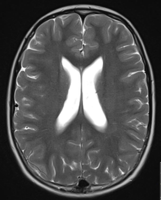 óssea se inicio de sintomas neurológicos/alteração imagem RMN-CE BIOQUIMICA H. HP VALORES LOCAL REFERÊNCIA Glicose (mmol/l) 3.6 5.4 4.8 4.2-6.