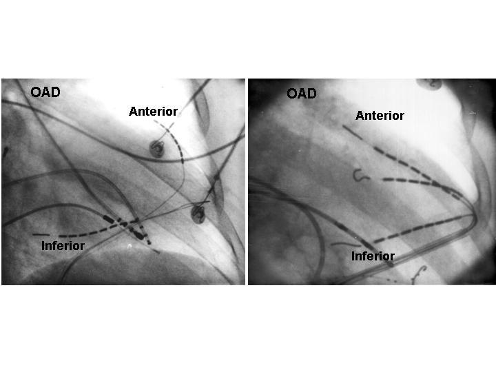 Figura 2 - Mapeamentos endocárdico e epicárdico simultâneos utilizando dois e três micocateteres nas regiões anterior e inferior.