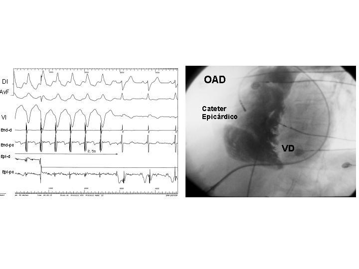 Figura 3 - Potenciais mesodiastólicos foram registrados durante taquicardia ventricular sustentada localizada no ventrículo direito.