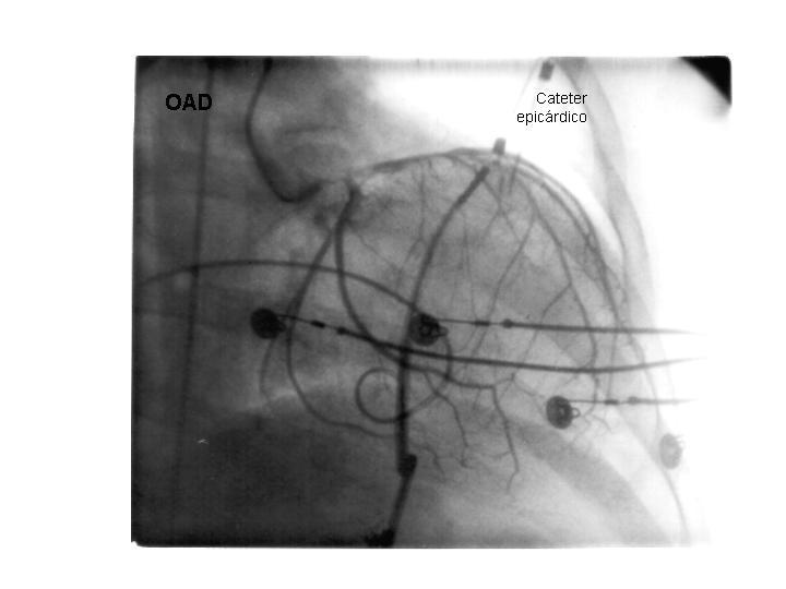 Figura 4 Cineangiocoronariografia de artéria coronária esquerda em projeção oblíqua anterior direita (OAD), demonstrando a proximidade do