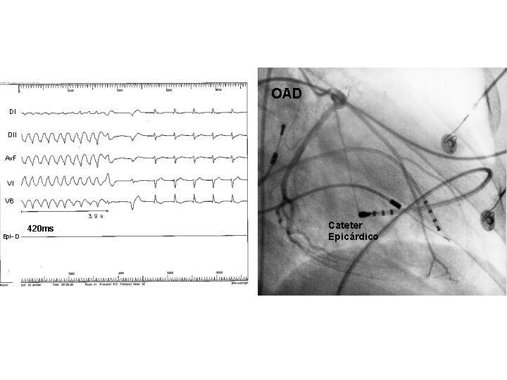 Figura 6 - A cineangiocoronariografia de artéria coronária esquerda em projeção oblíqua anterior direita (OAD), demonstrando o cateter de ablação em uma região