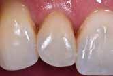 FinalTouch Correção estética do dente 12 FinalTouch branco, azul, laranja aplicado em