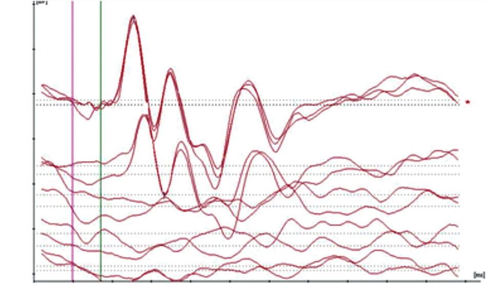 148 Gökdoğan Ç et al. (o limiar da RAETC foi considerado como sendo o a mais baixa intensidade em que estava presente um pico II de resposta reprodutível definido). Avaliamos como Categoria 3 (fig.
