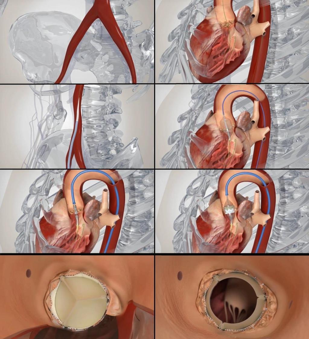 A figura 5 pretende esquematizar o procedimento de substituição valvular enquanto a figura 6 mostra como a imagiologia cine-angiográfica se torna decisiva na implantação do dispositivo.