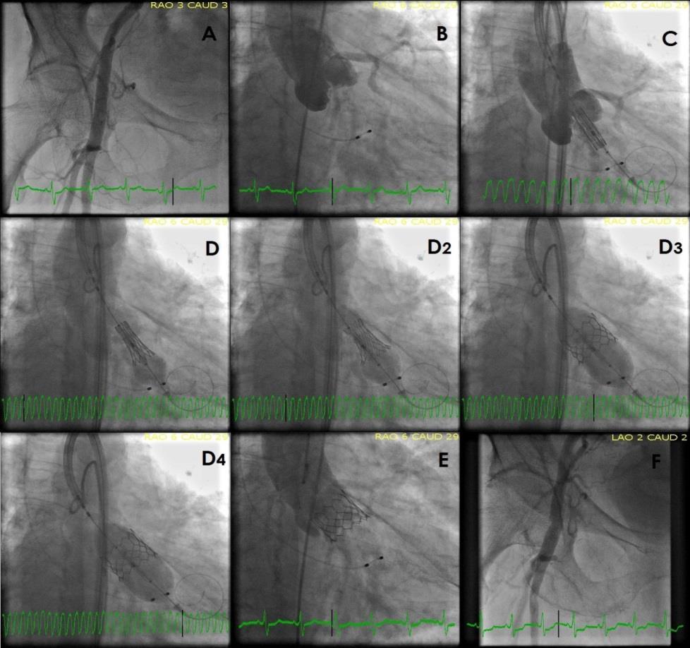 Figura 6 Imagens angiográficas procedimento de TAVI.