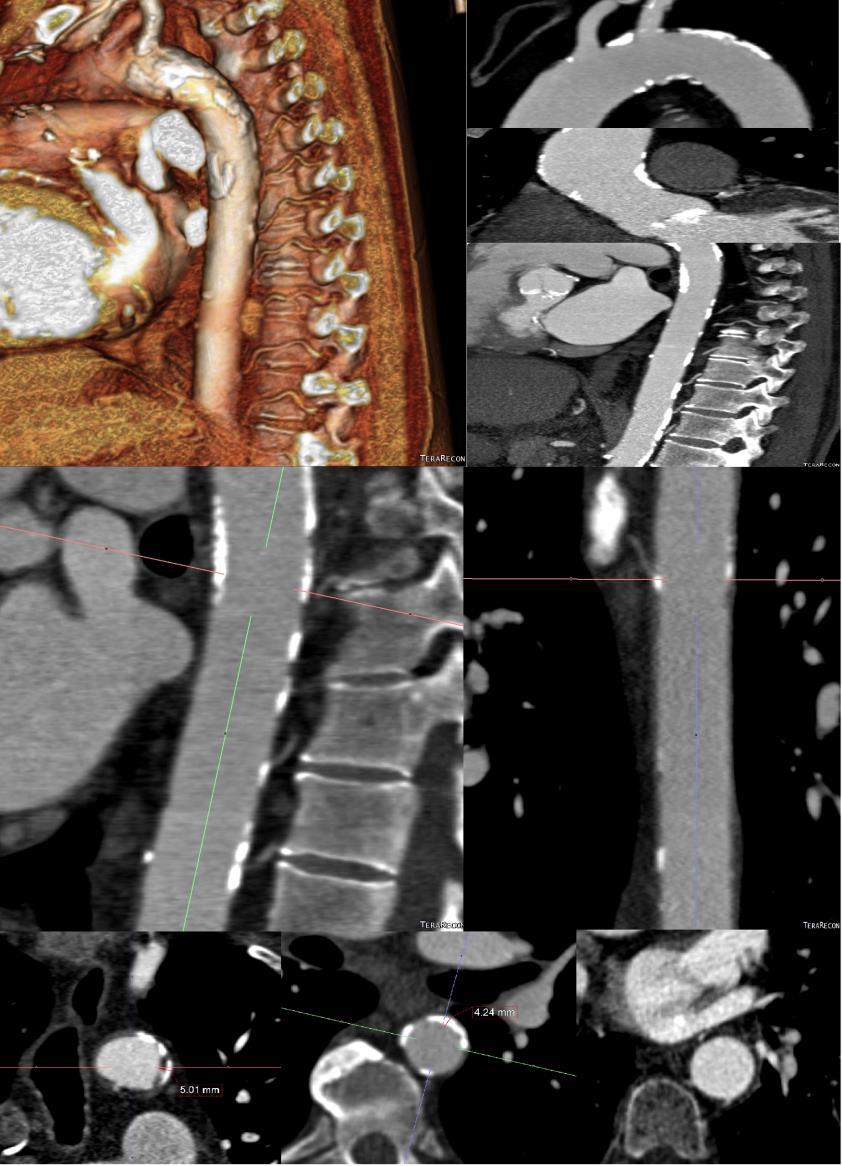 reconstruídas com 0,75mm de espessura. É utilizada técnica de tracking, sendo que o disparo é automático e ocorre quando é detetado contraste na aorta ascendente (valor superior a 150 UH).