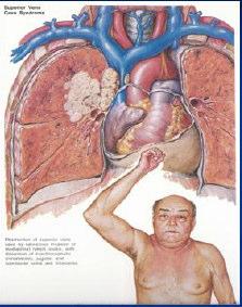 Outros compromissos: - Obstrução traqueal Dispneia alta/estridor - Compressão/invasão do esófago Disfagia - Obstrução linfática Derrame pleural - Linfangiose carcinomatosa intrapulmonar Tosse,