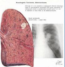 DIAGNÓSTICO e ESTADIAMENTO Tipos Histológicos de Carcinoma do Pulmão Os dois tipos principais de neoplasia do pulmão são: - carcinoma pulmonar não-pequenas células - carcinoma pulmonar de pequenas