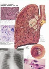 Carcinoma Pulmonar Não-Pequenas Células Adenocarcinoma O adenocarcinoma é o grupo histológico mais frequente (30-35%) e tem localização predominantemente periférica.