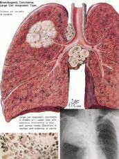 pode envolver o parênquima pulmonar e cavitar. Normalmente metastiza locoregionalmente (hilo/mediastino) mais tardiamente. Carcionoma de grandes células Corresponde a 10-20% do carcinoma do pulmão.