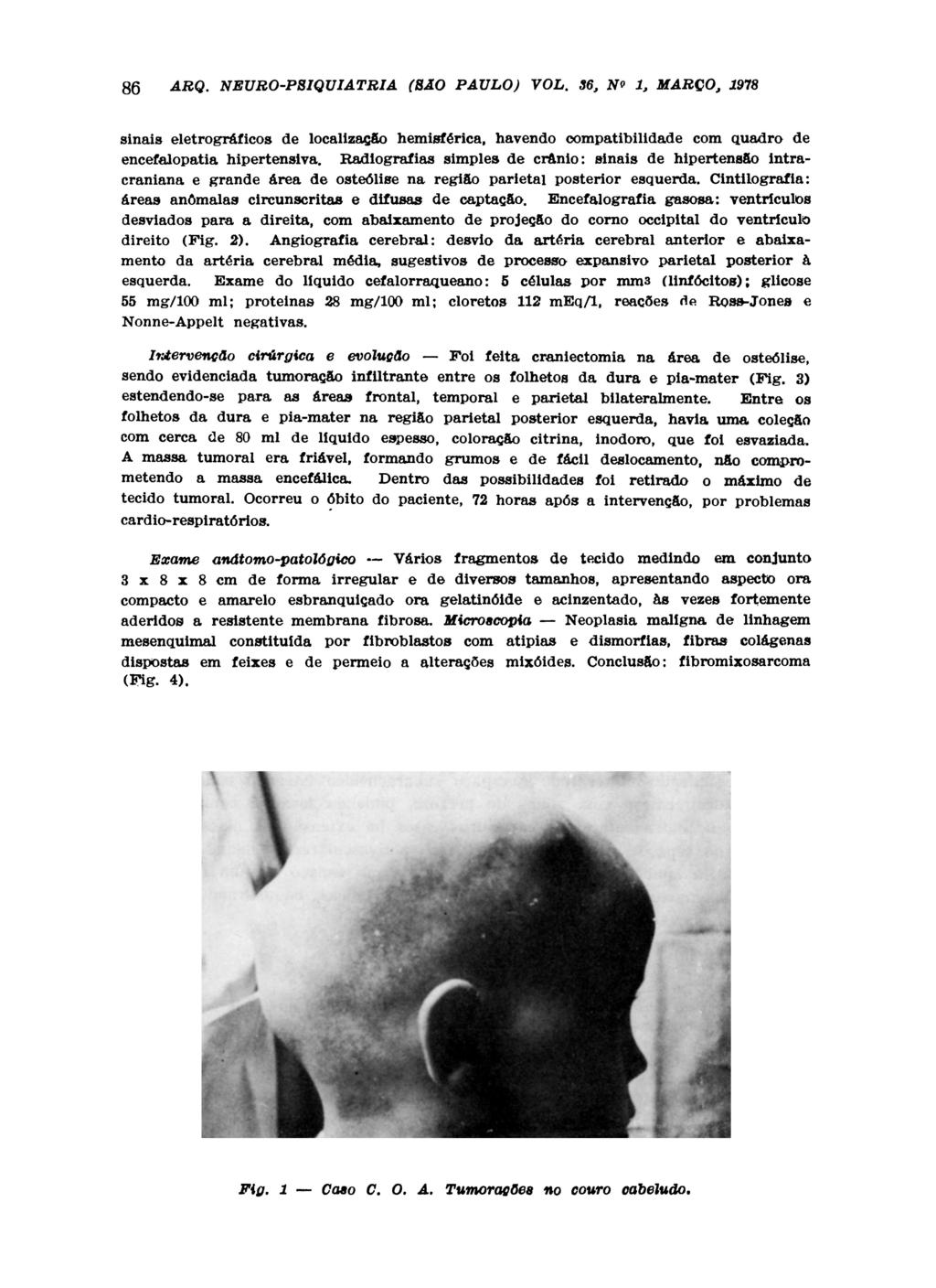 86 ARQ. NE UR O -P8IQ UIA ΤRI A (SÃO PAULO) VOL. 36, Ν* 1, MARÇO, 1978 sinais eletrográficos de localização hemisférica, havendo compatibilidade com quadro de encefalopatia hipertensiva.