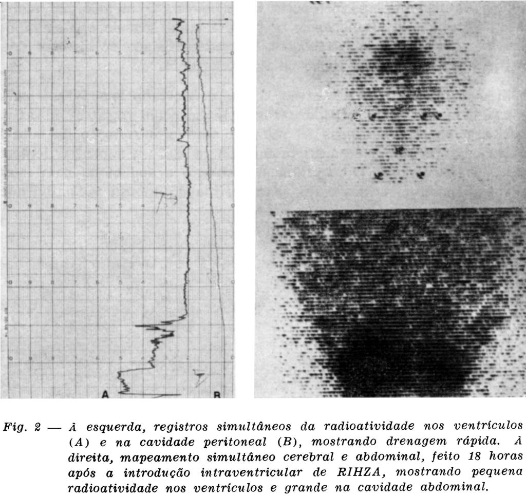 A figura 3 mostra os resultados em um caso em que não houve drenagem do líquido cefalorraqueano para a cavidade peritoneal. Nosso objetivo neste trabalho é a comunicação de um método pessoal de exame.