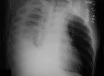 Exame físico: sem desconforto respiratório ou sinais de insuficiência circulatória. Diminuição de murmúrio vesicular na base pulmonar direita.