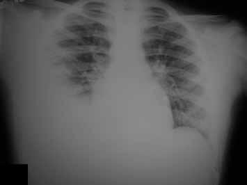 O paciente evoluiu com MV diminuído em ambas as bases pulmonares, sem manifestações respiratórias clínicas, afebril, eupnéico e sem outras alterações ao