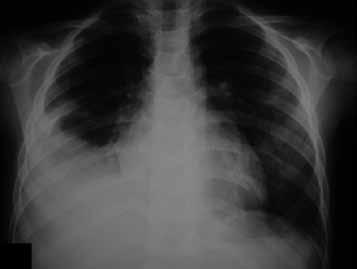 respiratório. Recebeu alta no dia seguinte. Fig. 4 - Radiografias consecutivas: velamento do seio costofrêmico E (); derrame pleural bilateral (); regressão do derrame ().
