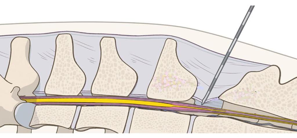 17 Figura 2 : Entrada da agulha de Tuohy no espaço epidural Fonte: CAMPOY, 2015. 2.1.2.1.3 Testes da gota em suspensão e da perda de resistência O posicionamento correto da agulha pode ser confirmado