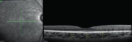 Variação da espessura da coroideia e da retina após sessão de hemodiálise avaliada por tomografia de coerência óptica de domínio espectral em modo enhanced-depth imaging PRESSÃO INTRA-OCULAR A