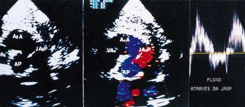 Arq Bras Cardiol Soares e cols grupos. Sobrecarga ventricular direita ocorreu em um paciente na forma isolada de JAoP, portador de HRP.
